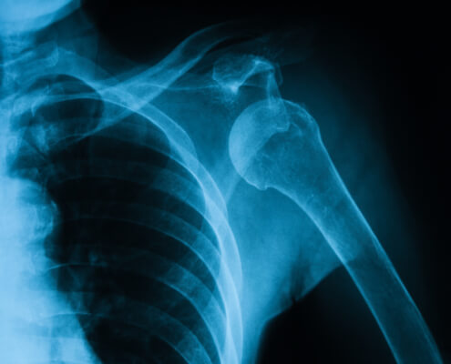 Röntgenbild einer Schulterluxation das eine ausgekugelte Schulter zeigt
