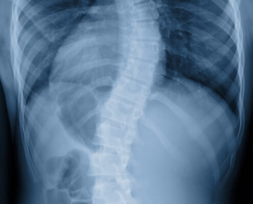 Skoliose-Röntgenfilm zeigt Wirbelsäulenverbiegung bei jugendlichem Patienten